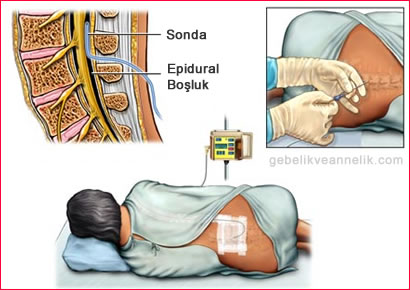 Epidural doğumda, doğumdan önce anne adayının belinden özel bir iğne ile omuriliğe yerleştirilen bir kateter aracılığıyla anestezi yapılır. Bu uygulamanın amacı belin alt kısmını uyuşturarak ağrı hissini engellemektir. Diğer 