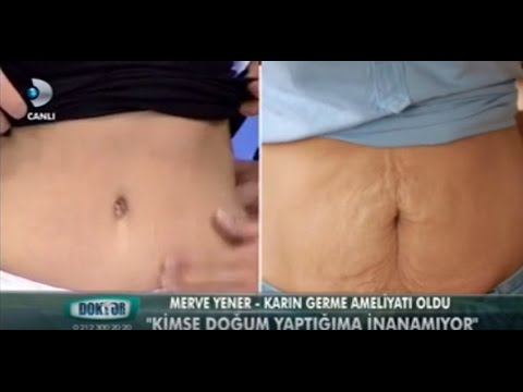 Karın germe ameliyatından sonra evde olduğunuzda, en azından ilk bir veya iki gün için birinin size yardım etmesi önemlidir. Hareket kabiliyetiniz biraz sınırlı olduğu için size ağrı kesici ve destek verecek birine ihtiyacını