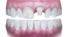 Hasarlı dişleri güçlendirmek ve korumak için kullanılır. Kaplama dişlerinizi iyi temizlerseniz ve rutin bakım kontrollerinizi aksatmazsanız bu restorasyonları 10 yıldan fazla rahatlıkla kullanabilirsiniz.