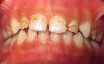 Süt dişi çürüğü çocuklar için önemli bir sorun olabilir, ancak bir diş hekiminin yardımıyla ebeveynler çocuklarının ağzını sağlıklı ve diş çürüğünden arındırabilir.